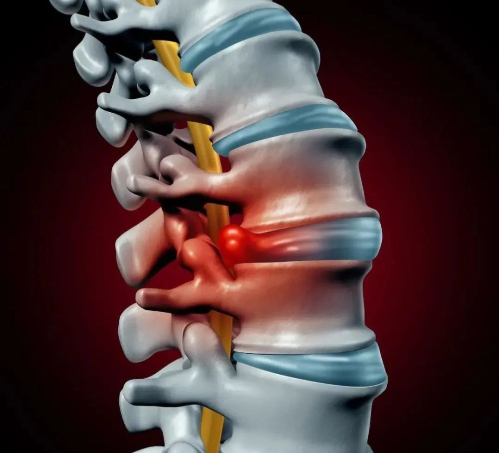 青壯年不明原因腰臀腿痛坐骨神經受累小心腰椎間盤突出症