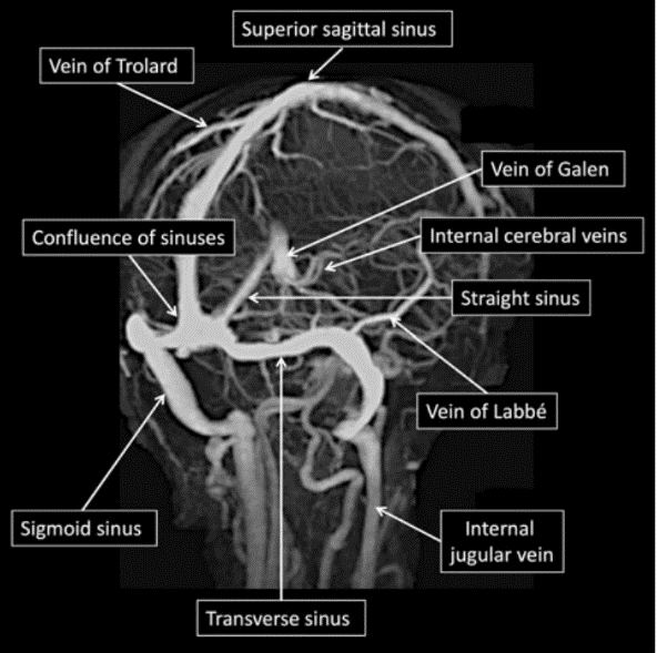 深静脉系统的较大静脉(包括大脑内静脉,rosenthal静脉和galen静脉)