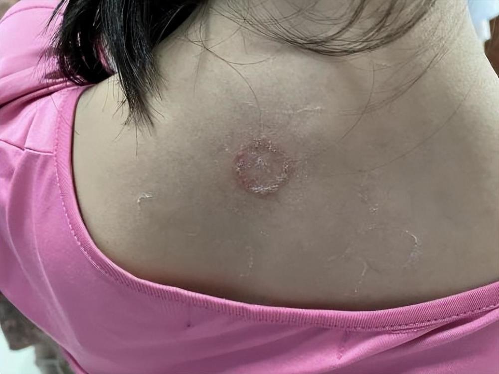 猫癣并没那么可怕,了解这些就很好治愈,铲屎官别吓唬自己_腾讯新闻