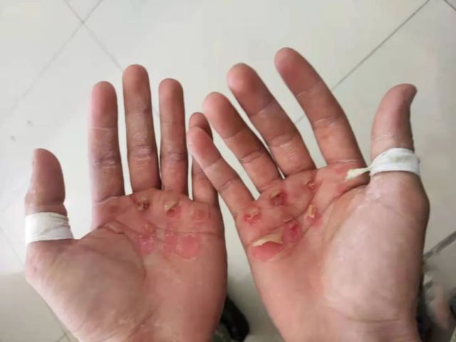 比赛结束,韦承喜双手大面积破皮.