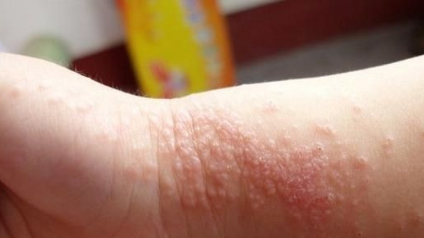 肤康科普 秋季湿疹容易复发加重 应正确认识湿疹 积极预防 腾讯新闻