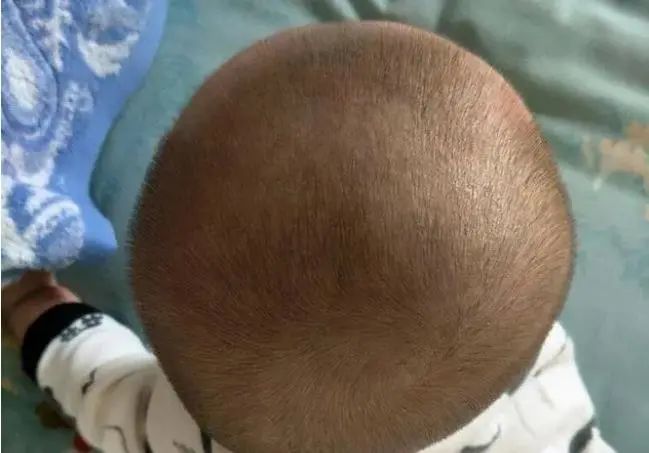 婴儿4个月小头症图片图片