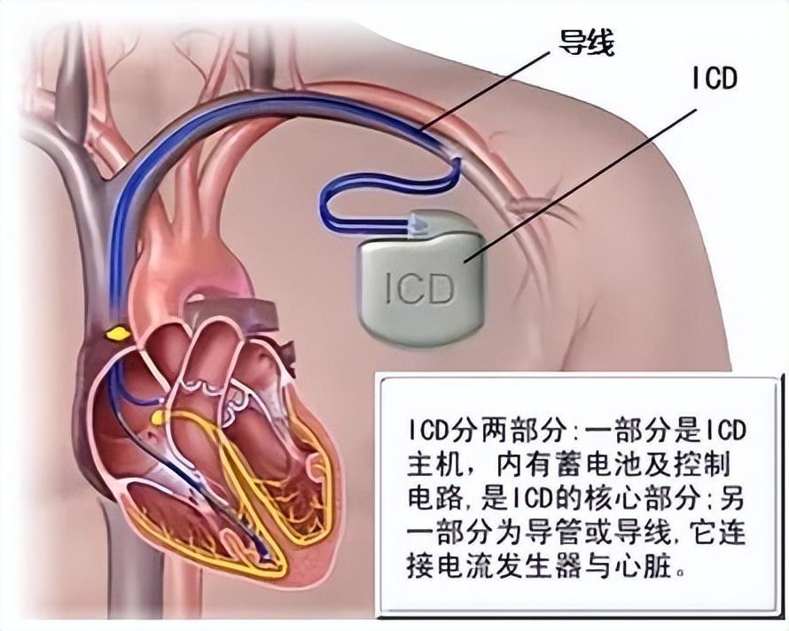 62岁大爷频发胸闷,心悸,医生在他体内装上除颤仪护命_腾讯新闻