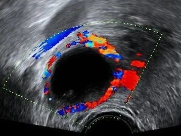 卵巢冠囊肿超声图片图片