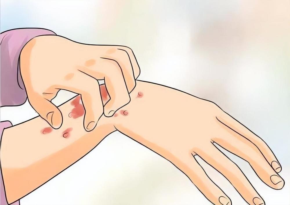 皮肤瘙痒有风团 医生:别大意!可能是荨麻疹_腾讯新闻