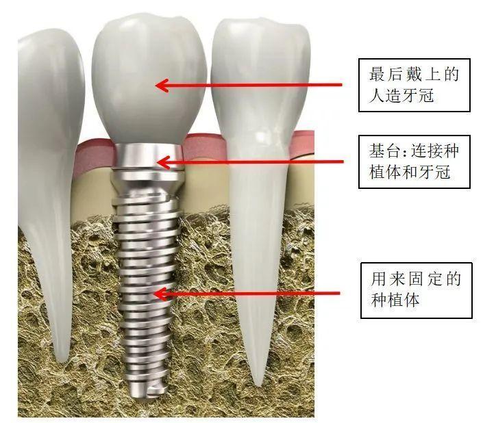 福州種植牙過程種植牙與傳統假牙的區別