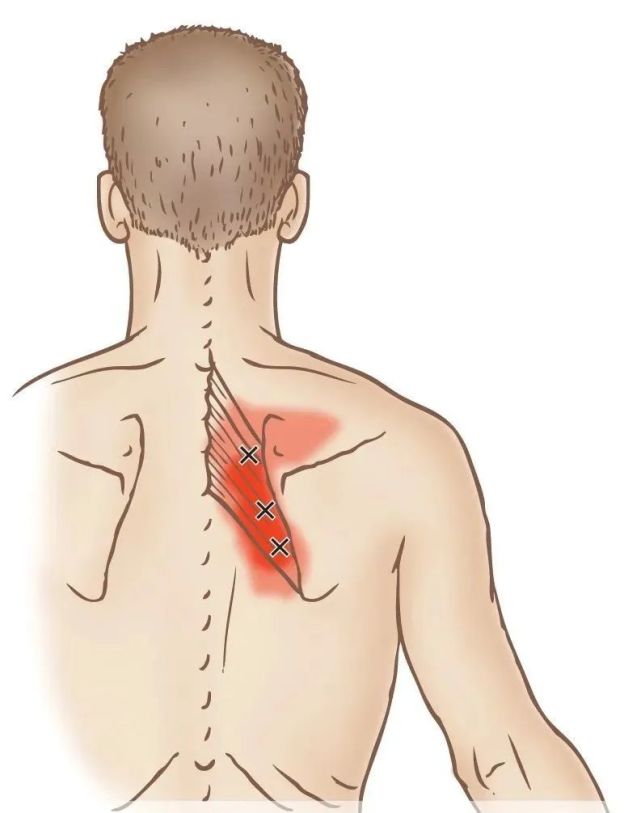 肩胛骨內側緣的疼痛和前鋸肌有關
