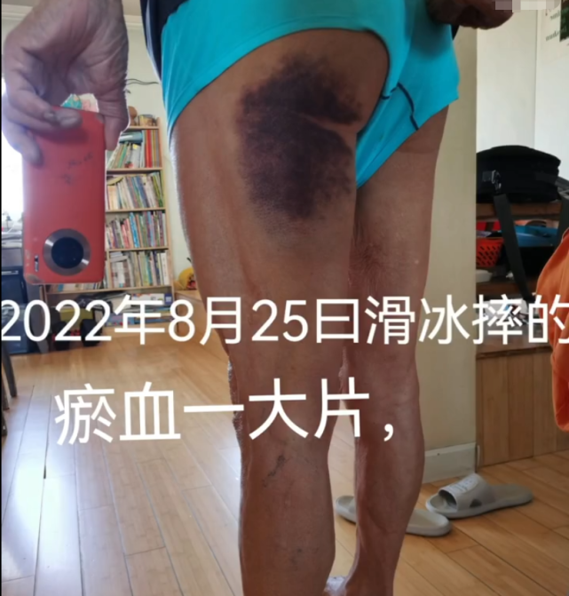 腿部大片淤血太渗人,不去医院坚持自我愈合_腾讯新闻