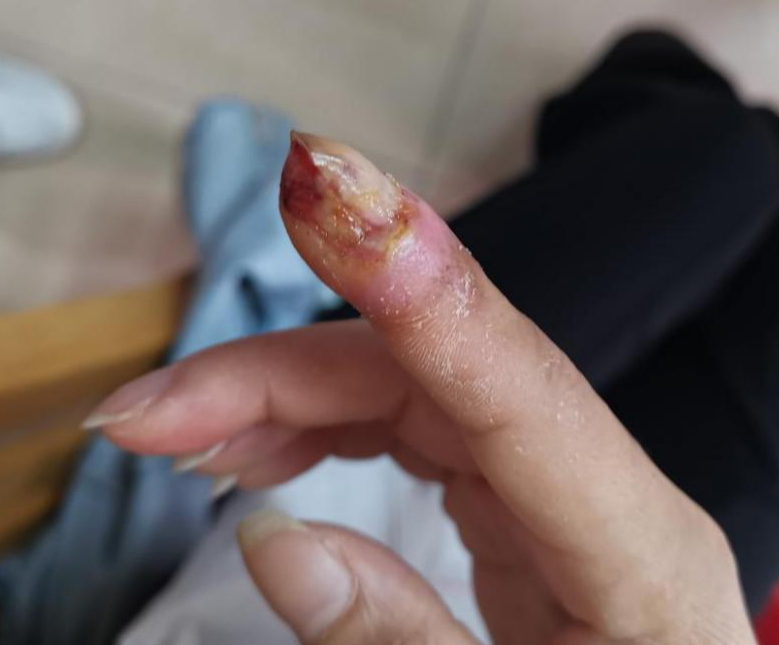 一个多月的工作,导致光明女子手指溃烂?涉事公司被罚7.5万_腾讯新闻