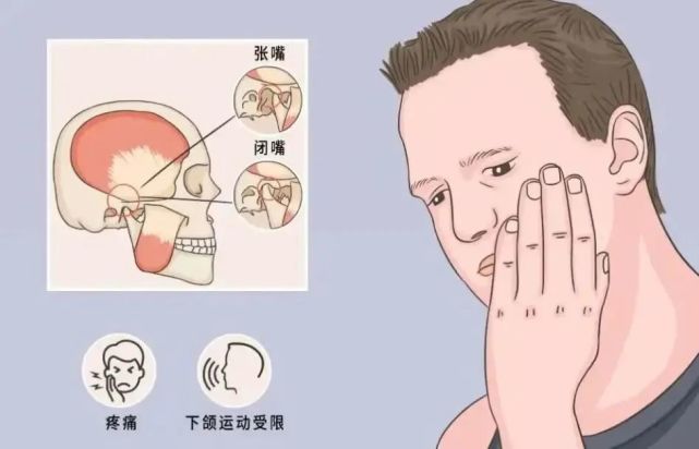 为清脆的单响或者碎裂的连响声;下颌运动障碍包括有咬合不力,张口受限