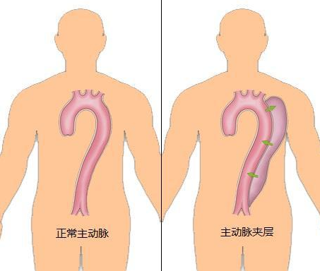 主动脉夹层是什么?