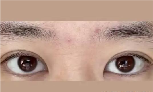 郑州美莱科普单侧是内眦赘皮,可以只开一侧眼角吗?