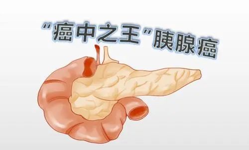 胰腺癌:4個症狀,可能是胰腺呼救聲