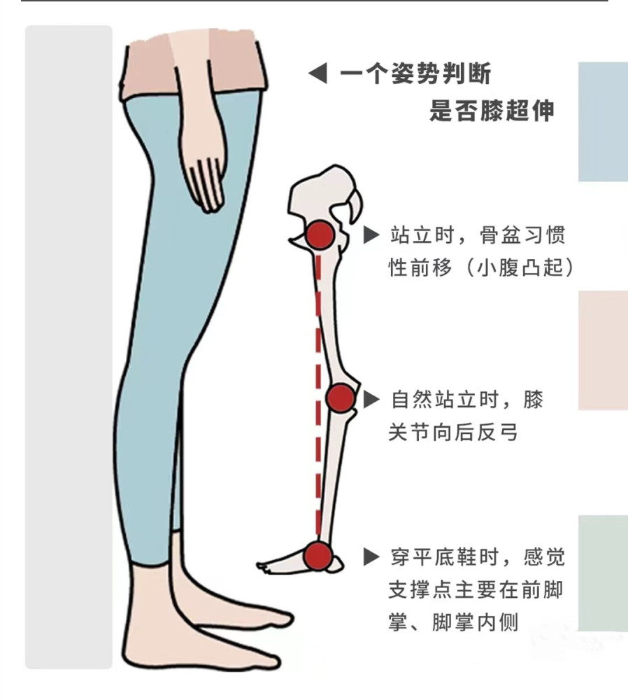 脊地小課堂膝超伸腿粗肚子凸5個動作改善腿型