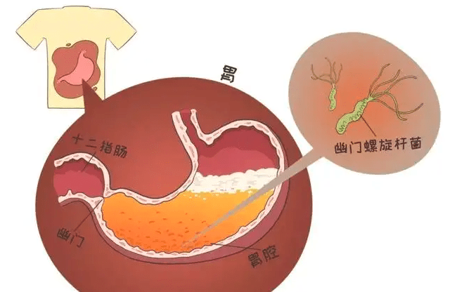 李竹庭主任:長期口臭別不當回事,有些口臭可能是胃癌表現