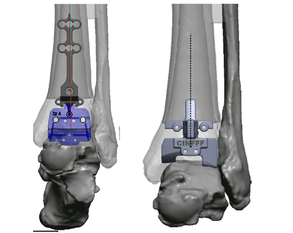 西安市红会医院完成"双定制"全踝关节置换术_腾讯新闻
