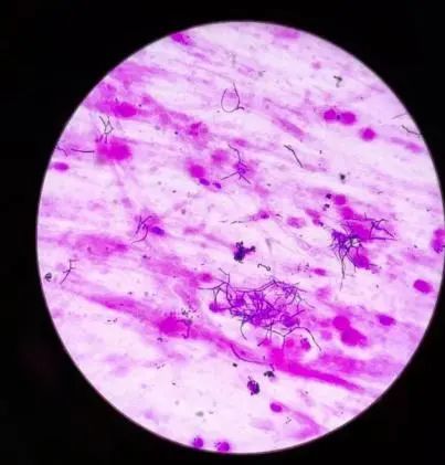 1例皮疽诺卡菌引起的肺部感染_腾讯新闻