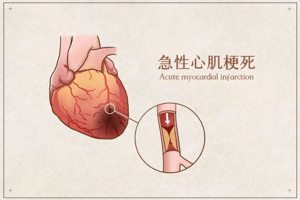 关羽扮演者陆树铭心梗去世急诊科医生预防心梗不能放过这些痛