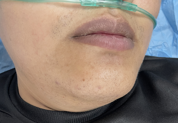 度远低于正常值她的口唇与甲床泛紫医生接诊时发现出现了不适症状家住