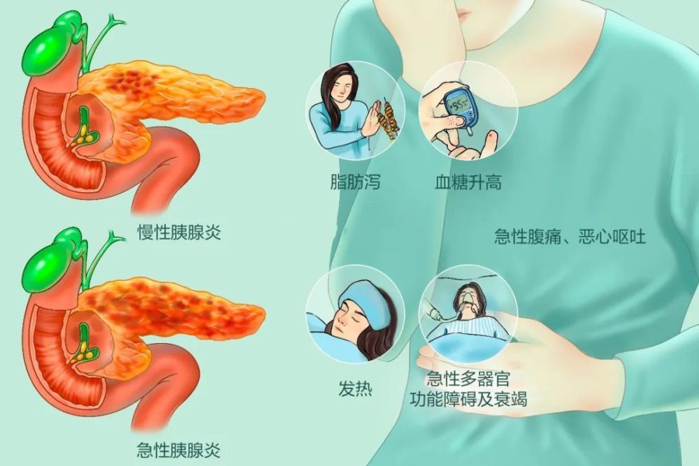 水肿,出血甚至坏死的炎症反应,根据其最常见的病因分为胆源性胰腺炎