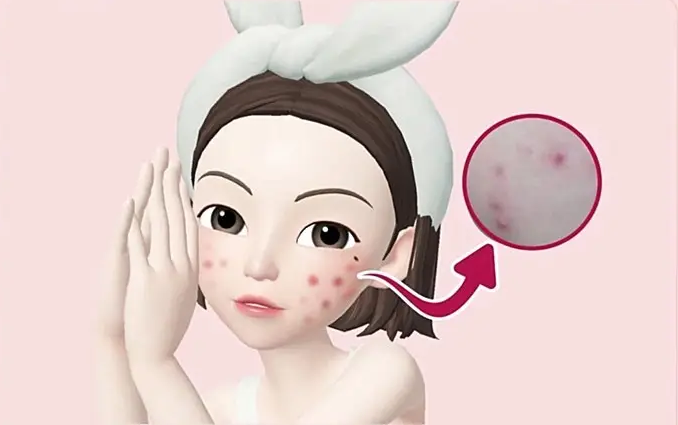 昆明皮肤管理中心:痘坑形成的原因?痘痘管理要多久才能见效?插图2