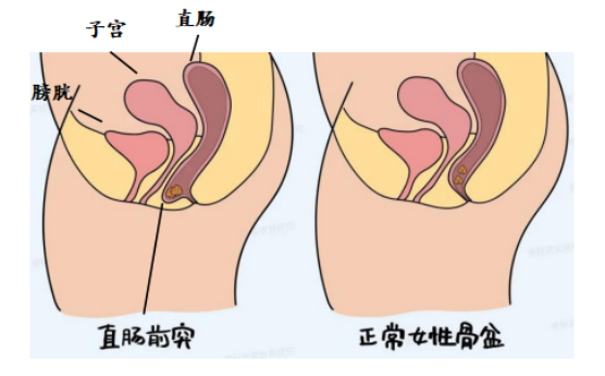 直腸前突直腸前壁突出,是指直腸前壁向陰道內膨出.