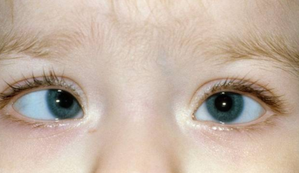 新生儿斗鸡眼需要治疗吗先别慌专家教你辨别真假对眼