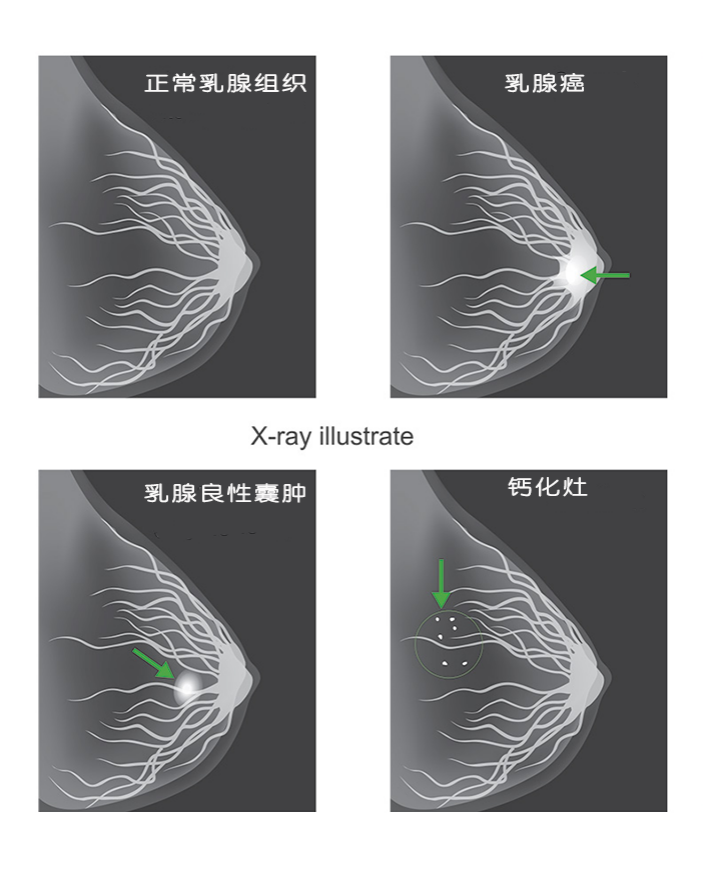 乳腺照片和乳腺钼靶图片