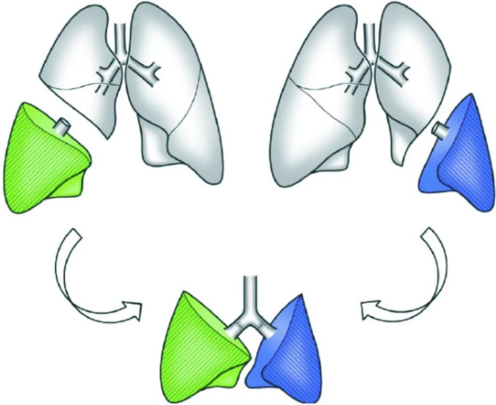 图14 活体双肺叶移植术手术示意图虽然ldllt最初起源于美国,但由于