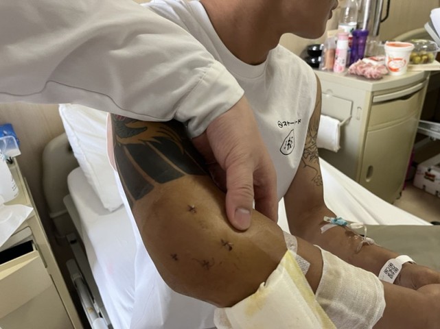 小伙儿打篮球摔断手肘医生打4个小孔完成关节复位