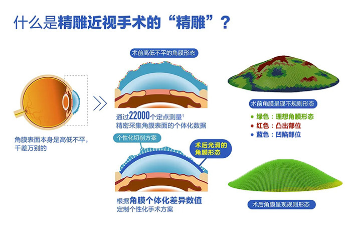 貼合近視眼角膜特徵矯正精雕飛秒近視激光手術寧波鄞州眼科醫院