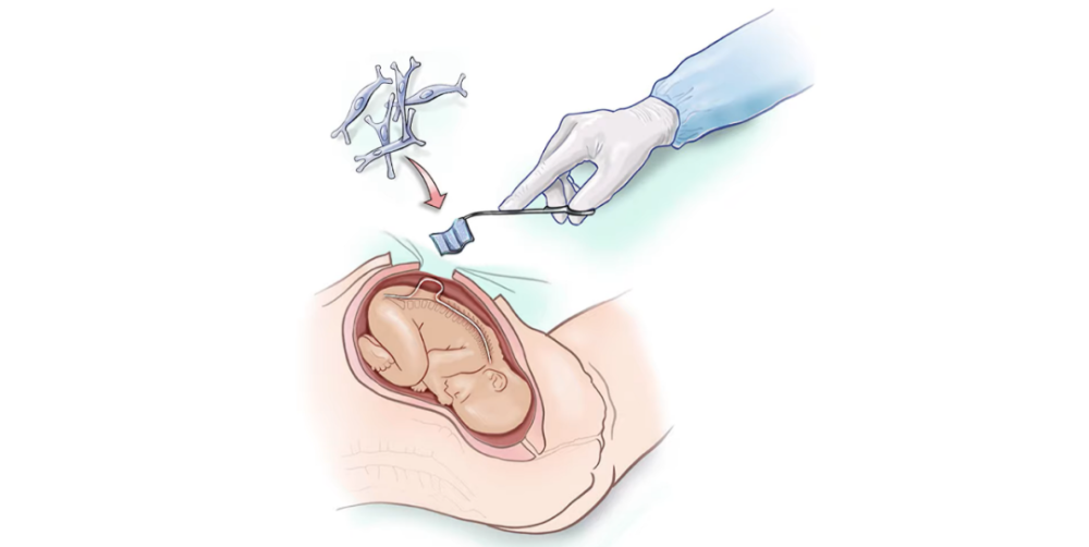 子宫内用干细胞修补脊柱裂母胎医学首创历史