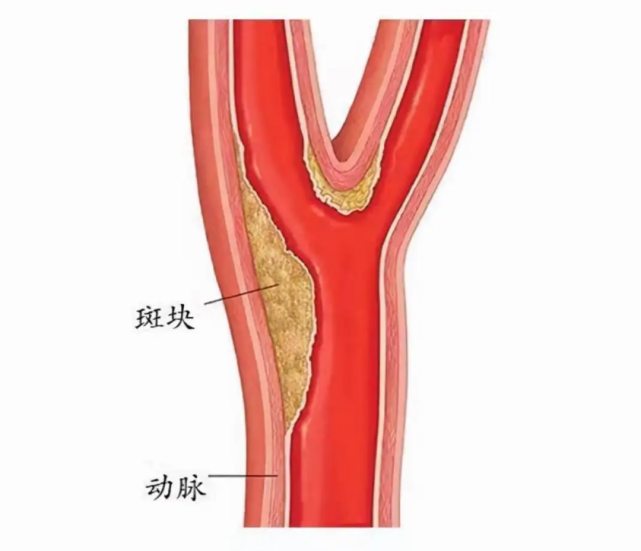 【人民61科普】查体发现颈动脉斑块,管?还是不管?