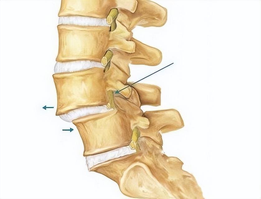 腰椎滑脫後,可以通過按摩,鍛鍊等保守方法讓腰椎復位嗎?_騰訊新聞