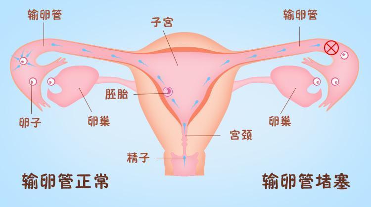 上海禾新医院生殖与不孕专科：输卵管堵塞5原因﹣你是第几种-