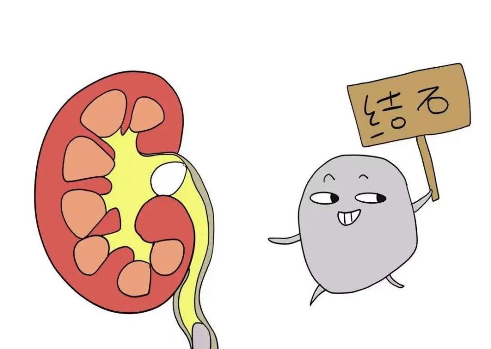 上海是结石的高发地区,而我国又是全世界三大结石高发地区之一.