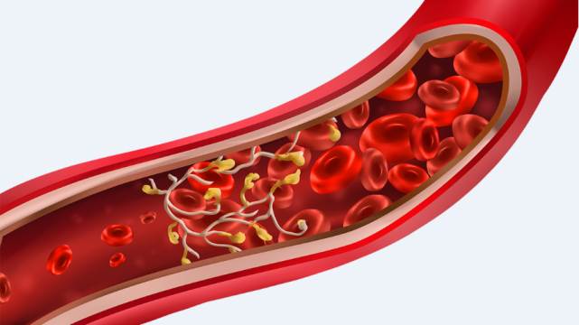 世界血栓日让生命流动拒绝被栓住