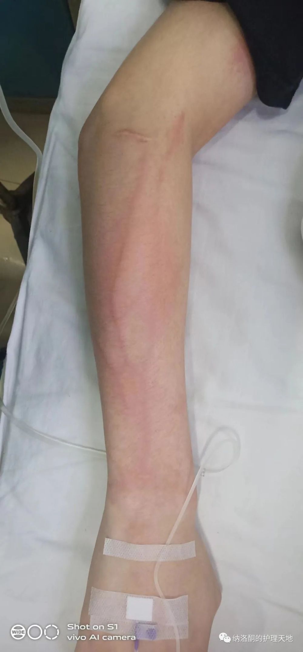 输左氧氟沙星注射液10分钟,患者输液的这根血管变成这样了!_腾讯新闻