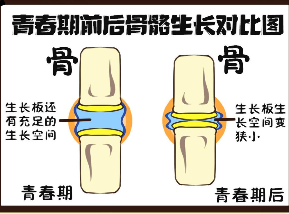 專家觀點:從醫學上來說,當骨骼線完全閉合時,人的身高就固定了,這時再