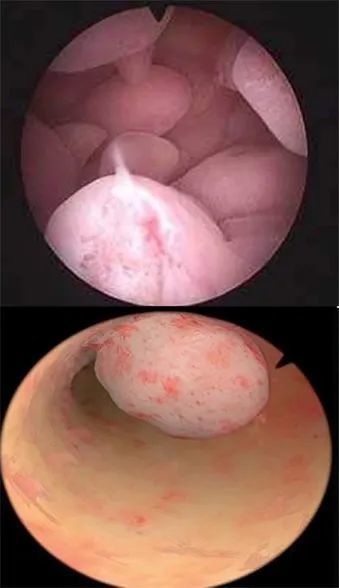 子宫里面长息肉图片图片