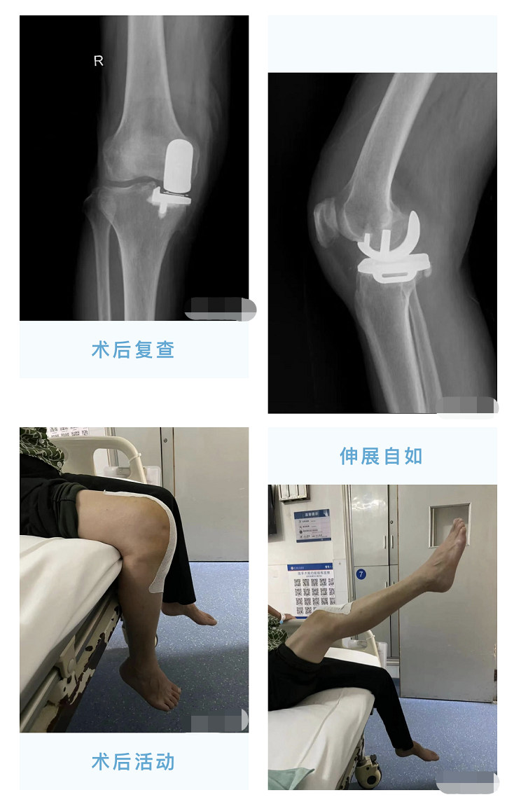 骨科微創新技術石門縣首例膝關節單髁置換術成功開展