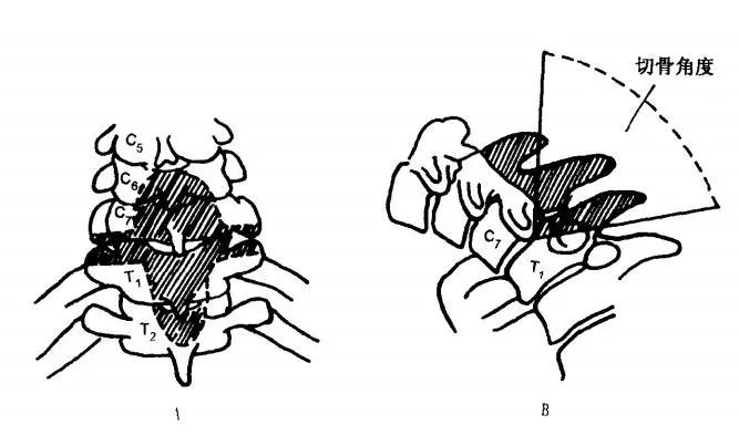 一文掌握頸椎屈曲畸形截骨矯正術