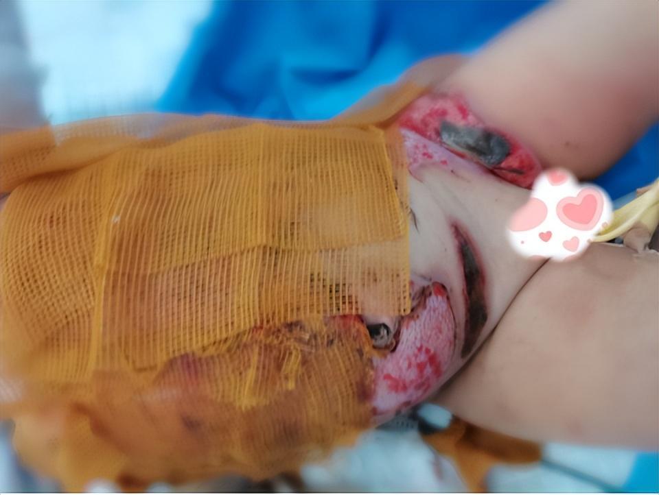 11个月婴儿皮开肉绽,大面积烫伤,竟是一壶沸水酿惨剧_腾讯新闻