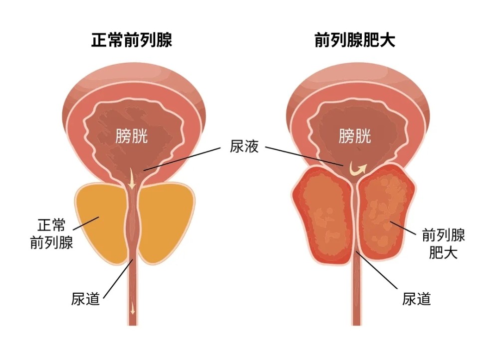 第二,中藥治療:綯煲的