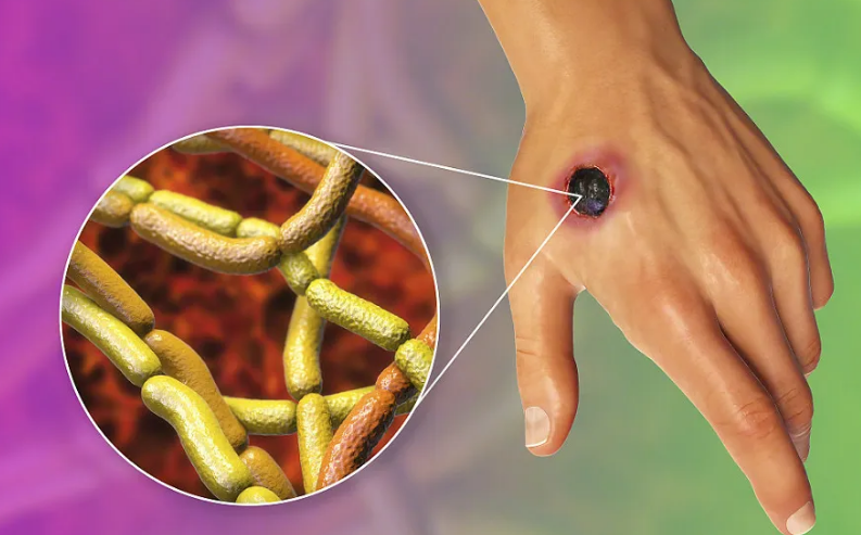 时隔一个月再次收治一皮肤炭疽患者专家提醒炭疽防治不可掉以轻心