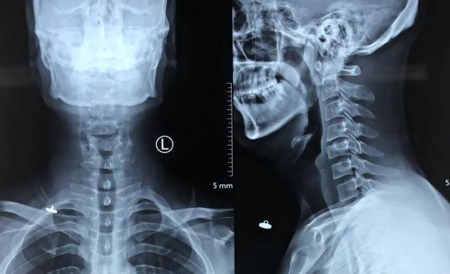 接诊后,仔细查体并完善相关检查后,诊断此患者为颈椎失稳伴椎间盘突出