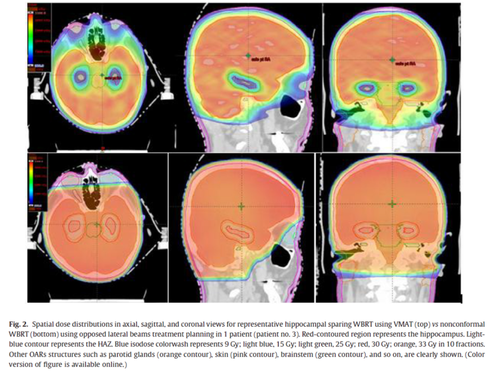 海馬區保護的全腦預防照射(ha-pci):新時代的新標準_騰訊新聞