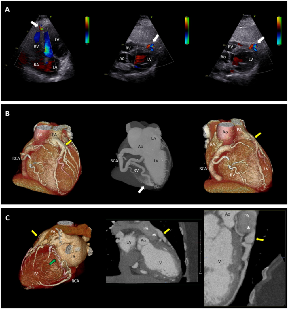 经胸超声心动图显示:左心室向心性肥厚,左心室射血分数(lvef)轻度降低