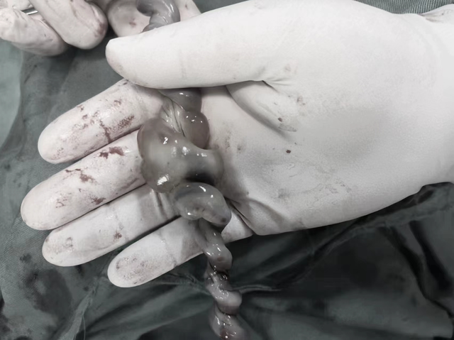 胎儿脐带扭转60多圈如"麻花"!医生生死营救"抢"回生命_腾讯新闻