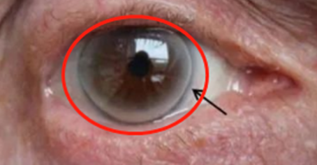 这是一种主要出现在角膜的周边部,也就是通常我们说的黑眼珠和白眼珠